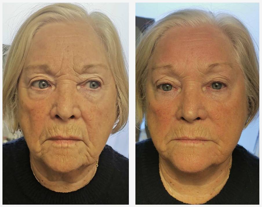 Full Face before and after results
