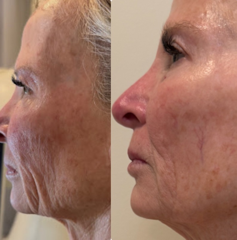Face & Jawline before and after results